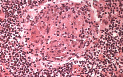 Histoplasmosis under a microscope